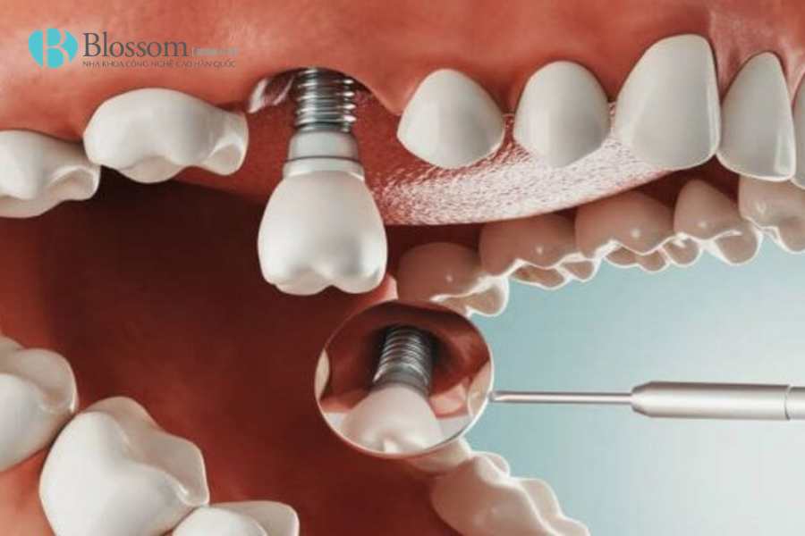 rang implant co bi sau 1