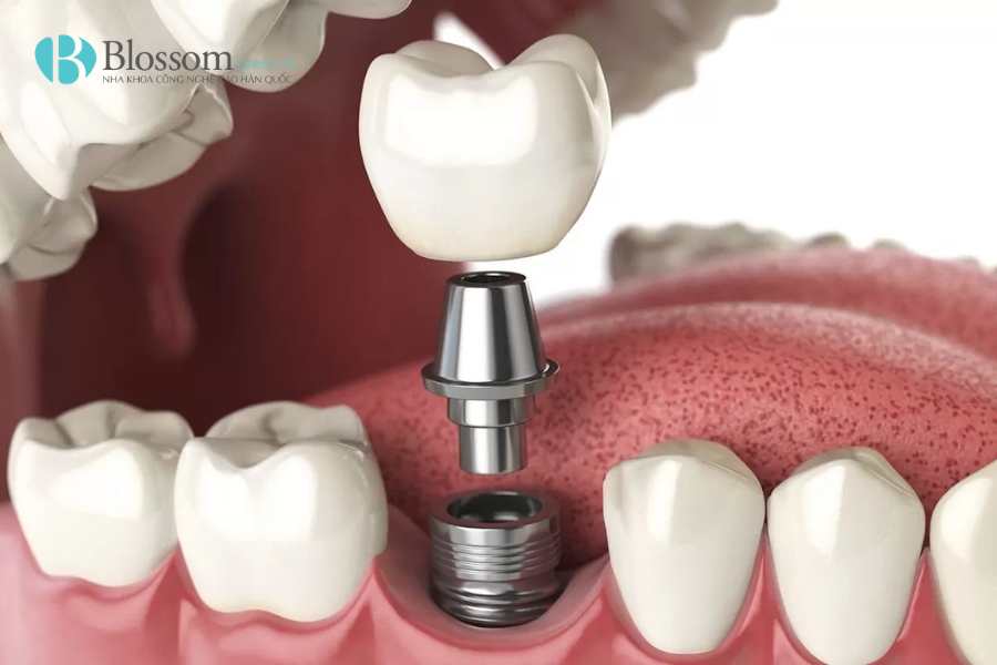 rang implant co bi sau 2