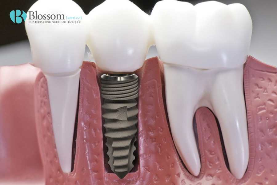 rang implant co bi sau 3