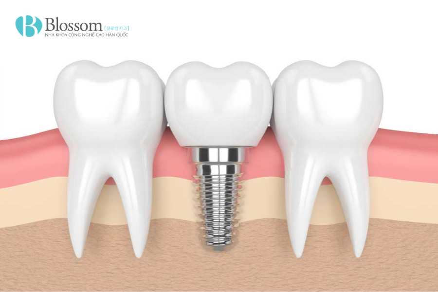 rang implant co bi sau 4