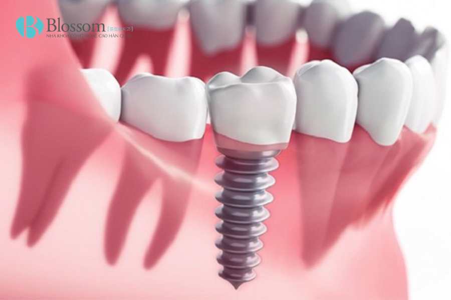 rang implant co bi sau 5