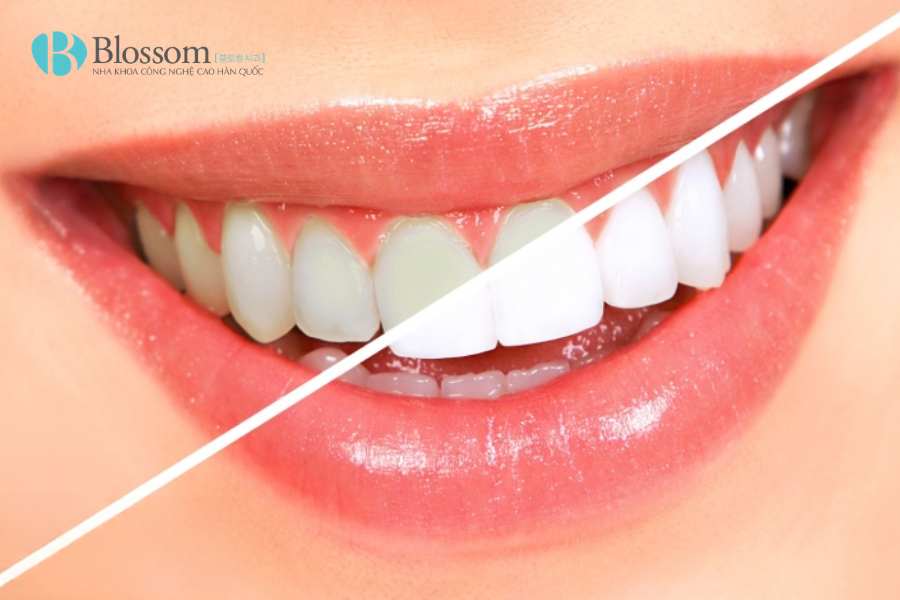 Răng sứ có tẩy trắng được không? Sự thật nhiều người làm răng sứ chưa biết 1 rang su co tay trang duoc khong 1