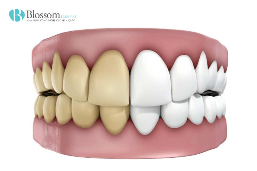 Răng sứ có tẩy trắng được không? Sự thật nhiều người làm răng sứ chưa biết 2 rang su co tay trang duoc khong 2