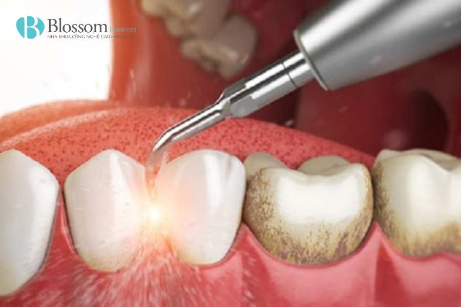 Răng sứ có tẩy trắng được không? Sự thật nhiều người làm răng sứ chưa biết 4 rang su co tay trang duoc khong 4