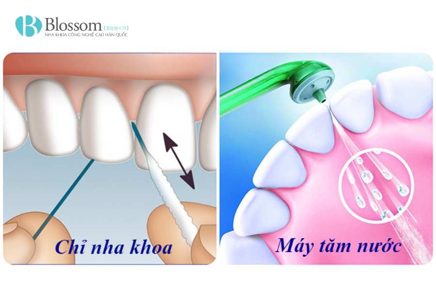Răng sứ có tẩy trắng được không? Sự thật nhiều người làm răng sứ chưa biết 5 rang su co tay trang duoc khong 5