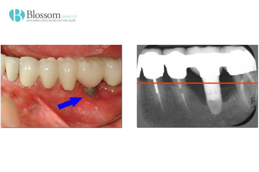 Trụ implant có bị gỉ sét không? Sự thật về độ bền và tính an toàn của implant 1 tru implant co bi gi set 1
