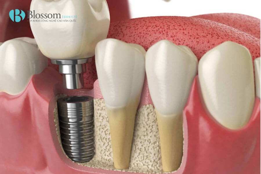 Trụ implant có bị gỉ sét không? Sự thật về độ bền và tính an toàn của implant 3 tru implant co bi gi set 3