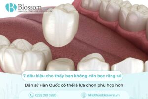 7 dấu hiệu cho thấy bạn không cần bọc răng sứ – Dán sứ Hàn Quốc có thể là lựa chọn phù hợp hơn