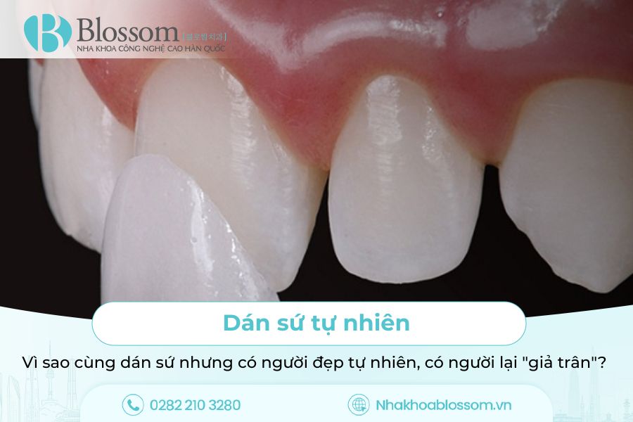 Dán sứ tự nhiên: Vì sao cùng dán sứ nhưng có người đẹp tự nhiên, có người lại “giả trân”?