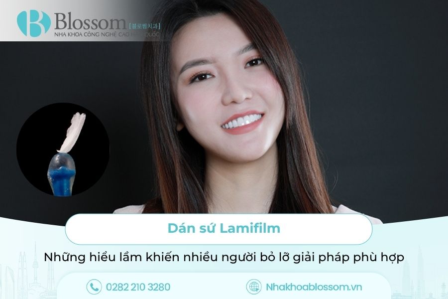 Dán sứ Lamifilm: Những hiểu lầm khiến nhiều người bỏ lỡ giải pháp phù hợp