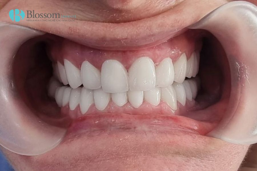 7 dấu hiệu cho thấy bạn không cần bọc răng sứ – Dán sứ Hàn Quốc có thể là lựa chọn phù hợp hơn 1 dan su han quoc 1