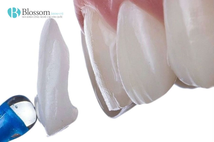 7 dấu hiệu cho thấy bạn không cần bọc răng sứ – Dán sứ Hàn Quốc có thể là lựa chọn phù hợp hơn 2 dan su han quoc 2