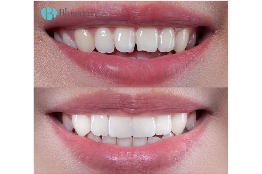 7 dấu hiệu cho thấy bạn không cần bọc răng sứ – Dán sứ Hàn Quốc có thể là lựa chọn phù hợp hơn 3 dan su han quoc 3
