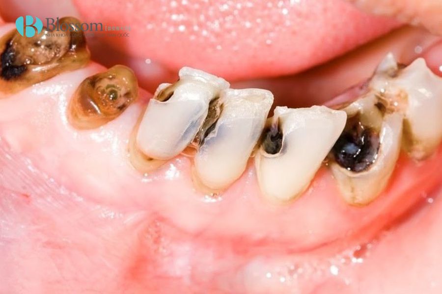 7 dấu hiệu cho thấy bạn không cần bọc răng sứ – Dán sứ Hàn Quốc có thể là lựa chọn phù hợp hơn 4 dan su han quoc 4