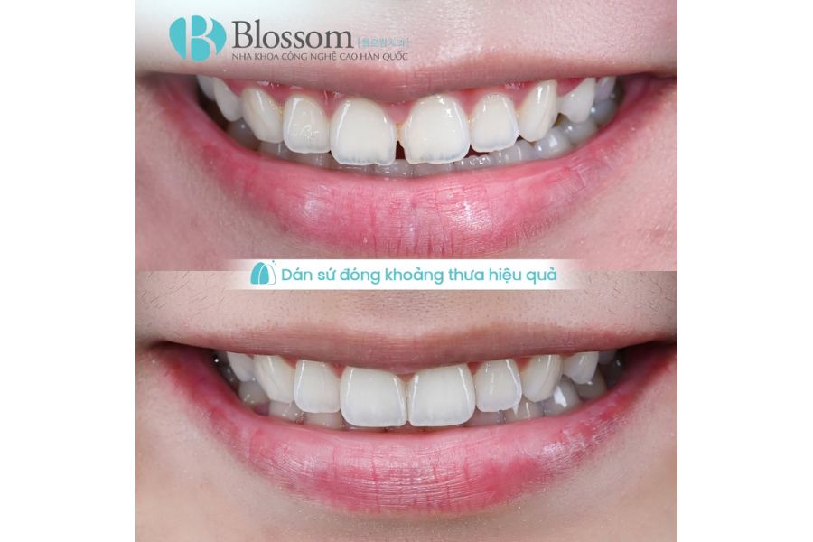 7 dấu hiệu cho thấy bạn không cần bọc răng sứ – Dán sứ Hàn Quốc có thể là lựa chọn phù hợp hơn 5 dan su han quoc 5
