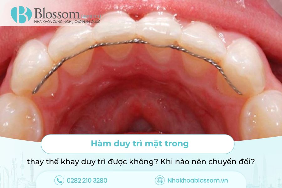 Hàm duy trì mặt trong thay thế khay duy trì được không? Khi nào nên chuyển đổi?