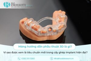 Máng hướng dẫn phẫu thuật 3D là gì? Vì sao được xem là tiêu chuẩn mới trong cấy ghép Implant hiện đại?