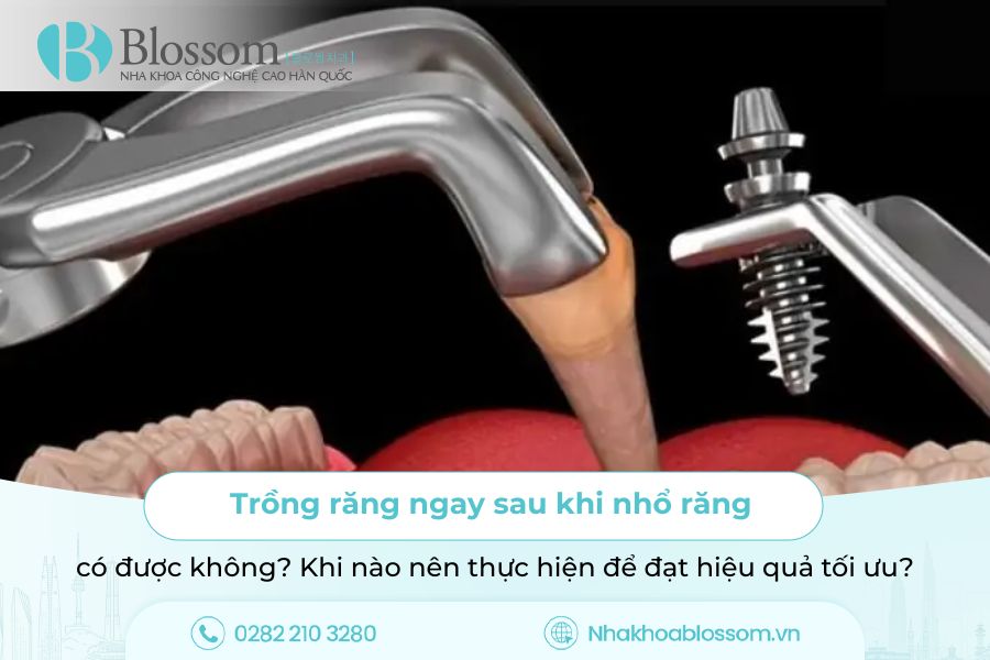 Trồng răng ngay sau khi nhổ răng có được không? Khi nào nên thực hiện để đạt hiệu quả tối ưu?